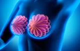 乳腺增生和乳腺结节，到底是什么关系？